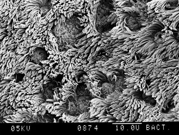 Human bronchus, hyperplasia of goblet cells. SEM
