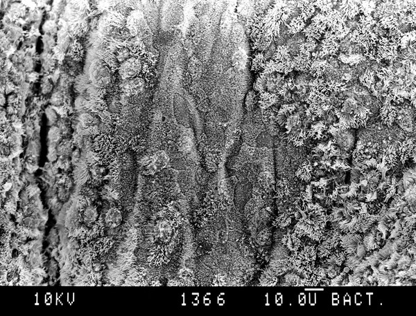 Human bronchus, hyperplasia, SEM