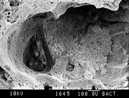 SEM lung with emphysema