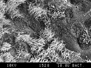 view Bronchus, hyperplasia. SEM