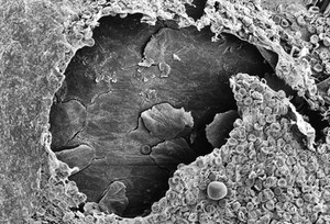 view SEM clot, showing squamous tissue beneath