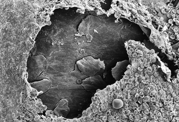 SEM clot, showing squamous tissue beneath