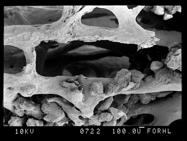 SEM bone, erosion of trabeculae
