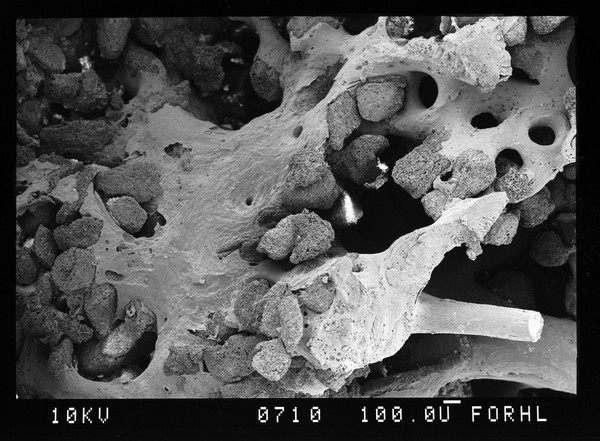 SEM new bone eroding