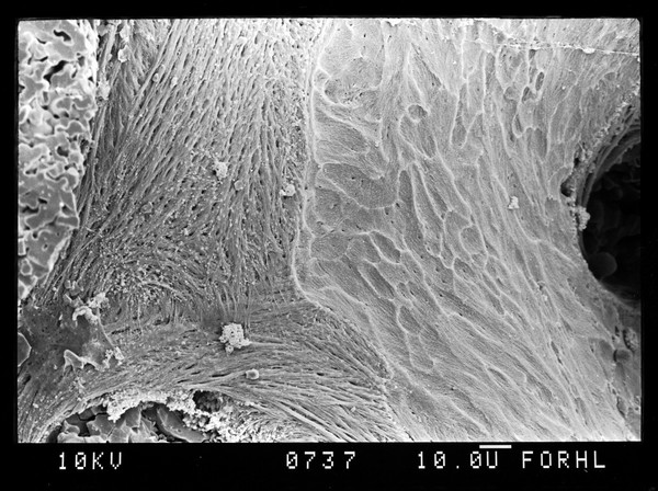 SEM eroding surface of osteoporotic bone