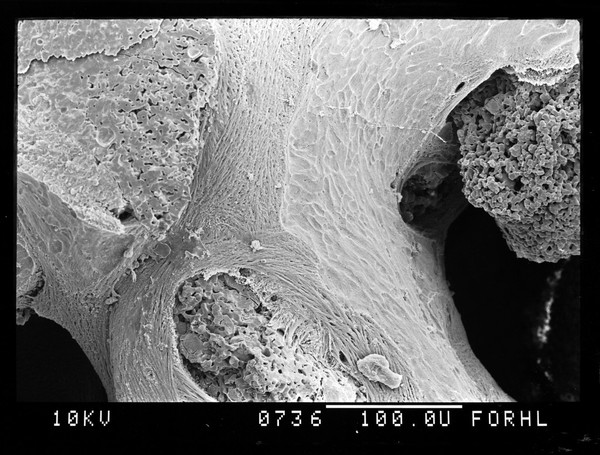 SEM new trabeculae in osteoporotic bone