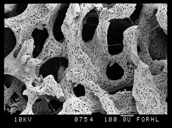 SEM bone, rotten trabeculae (osteoporosis?)