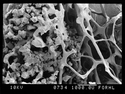 SEM of osteoporotic bone