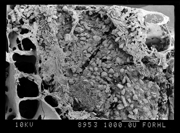 SEM bone, HA crystals and new bone