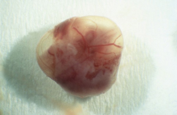 Foetus in amniotic sac