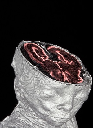 view Foetal MRI scan