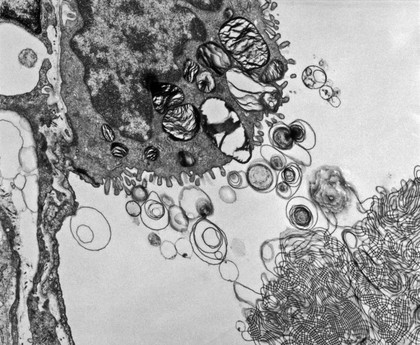 Surfactant in newborn lung