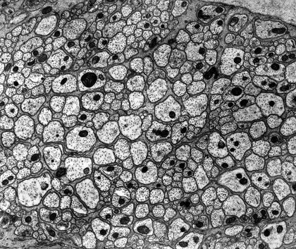 TEM of myenteric plexus