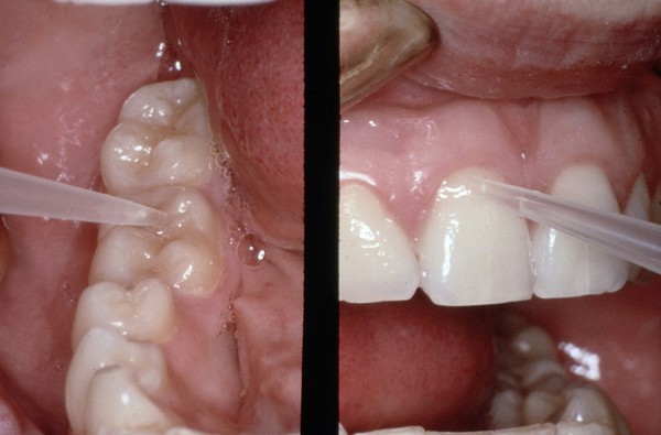 Antibodies to Streptococcus mutans on teeth