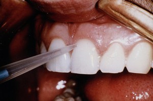 view Antibodies to Streptococcus mutans on teeth
