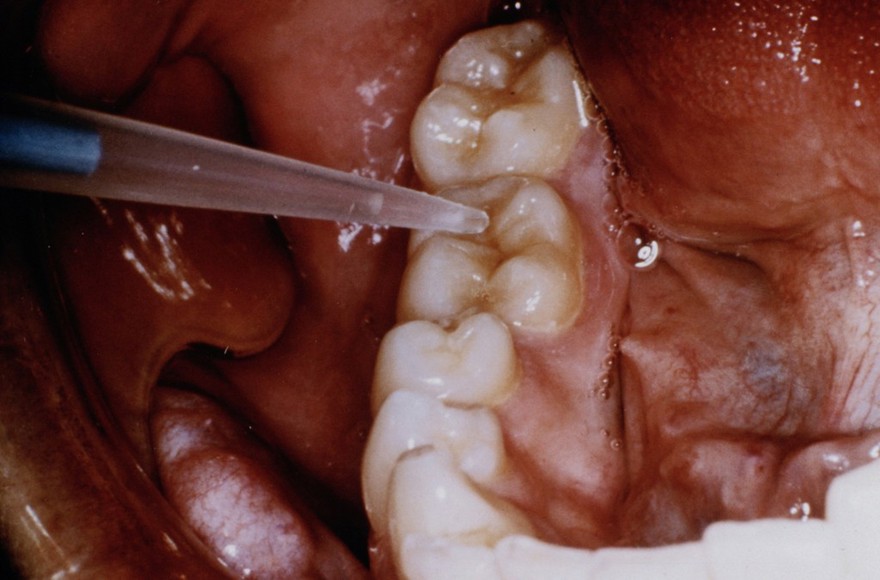 Antibodies to Streptococcus mutans on teeth