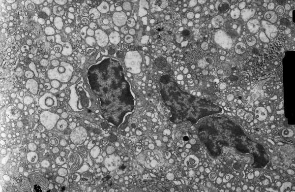 Plasma cell apoptosis - TEM