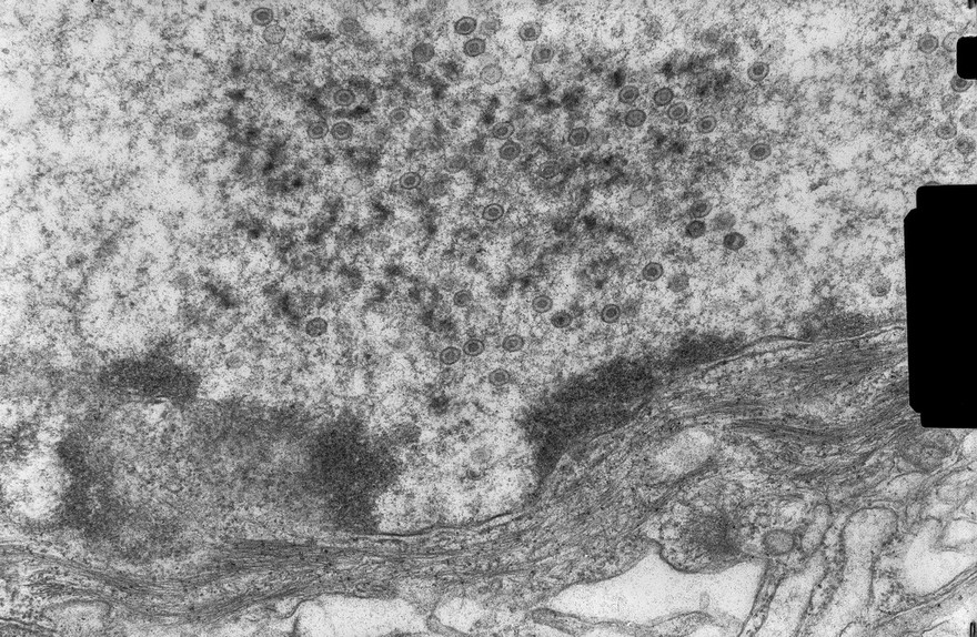 Herpes simplex viruses in cell nucleus