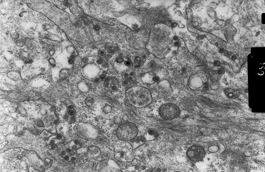 Herpes simplex viruses in epithelial cell
