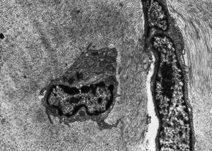 view Lymphocyte and keratocyte in corneal stroma