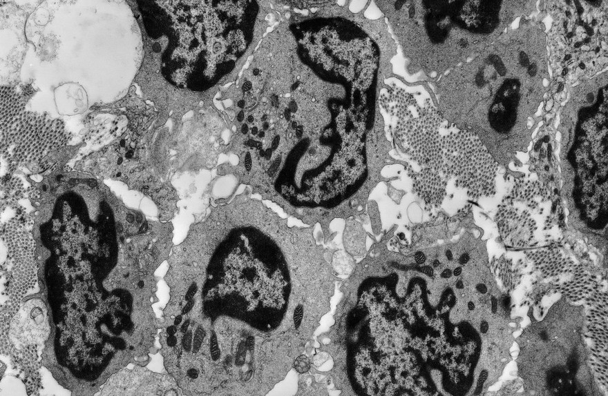 Massed small stromal lymphocytes - TEM