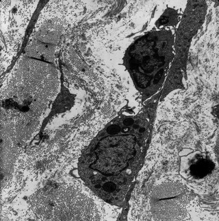 Macrophage/lymphocyte/fibroblast interaction