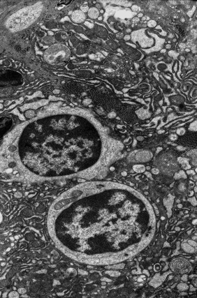 Lymphocytes and apoptotic plasma cells