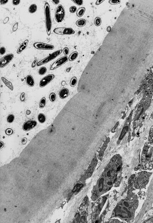view Fungal hyphae in the eye - TEM