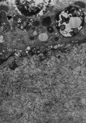 view Bowman's layer and inflammatory cells