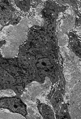 Macrophages in ulcerated corneal stroma