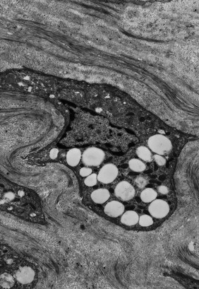 Corneal stromal cell with lipid vesicles