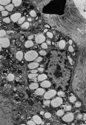 Cells with myelin figures and lipid droplets