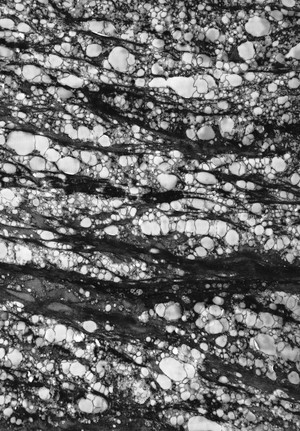 view Stromal vacuolation in cornea