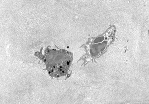 view Two granulocytes in the corneal stroma