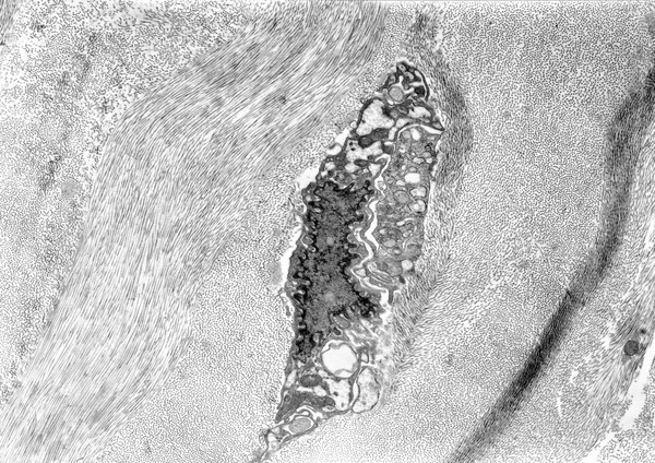 Unusual cell in the corneal stroma