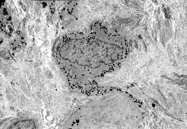 Melanocyte in the conjunctival stroma