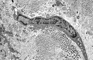 view Fibroblast in ulcerated scleral stroma