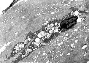 view Abnormal keratocyte in the corneal stroma