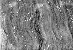 view Keratocyte in mid corneal stroma