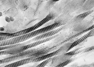 view Degenerating collagen fibrils in glaucoma