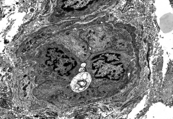 Occluded episcleral capillary