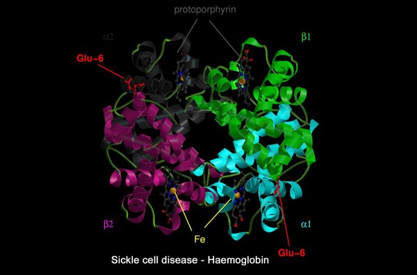 Sickle cell disease - mol. model haemoglobin