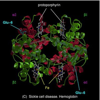 Sickle cell disease - mol. model haemoglobin