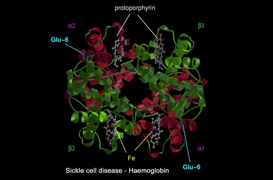 Sickle cell disease - mol. model haemoglobin