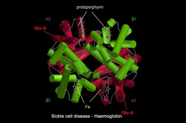 Sickle cell disease - mol. model haemoglobin