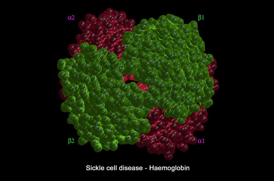 Sickle cell disease - mol. model haemoglobin