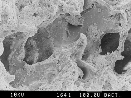 SEM emphysema in human lung, stereo.,LH