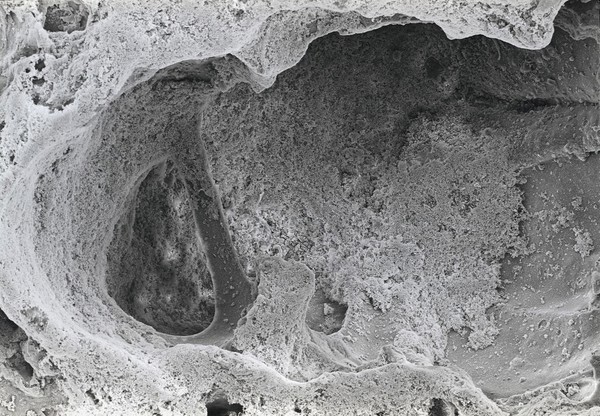 SEM emphysema in human lung, stereo.,LH