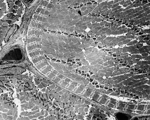 view Muscle biopsy showing ringed fibres