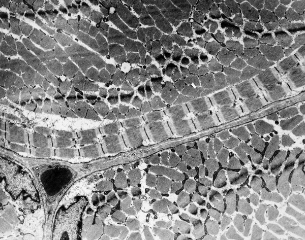 Muscle biopsy showing ringed fibres - HP
